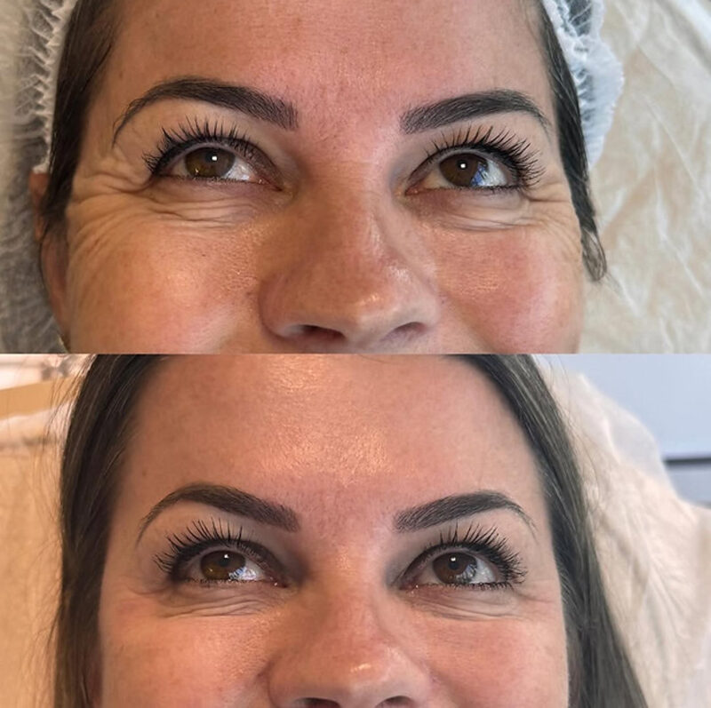 Botox  Toxina Botulínica