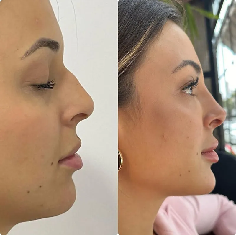 Perfiloplastia