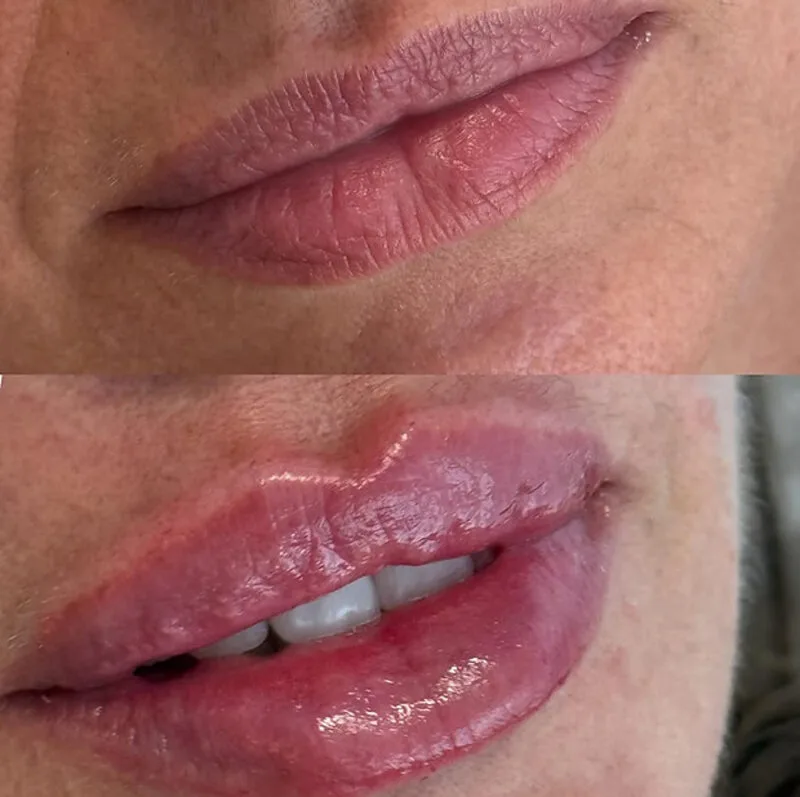 Preenchimento Labial