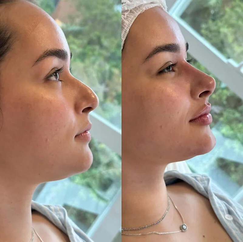 Harmonização Facial