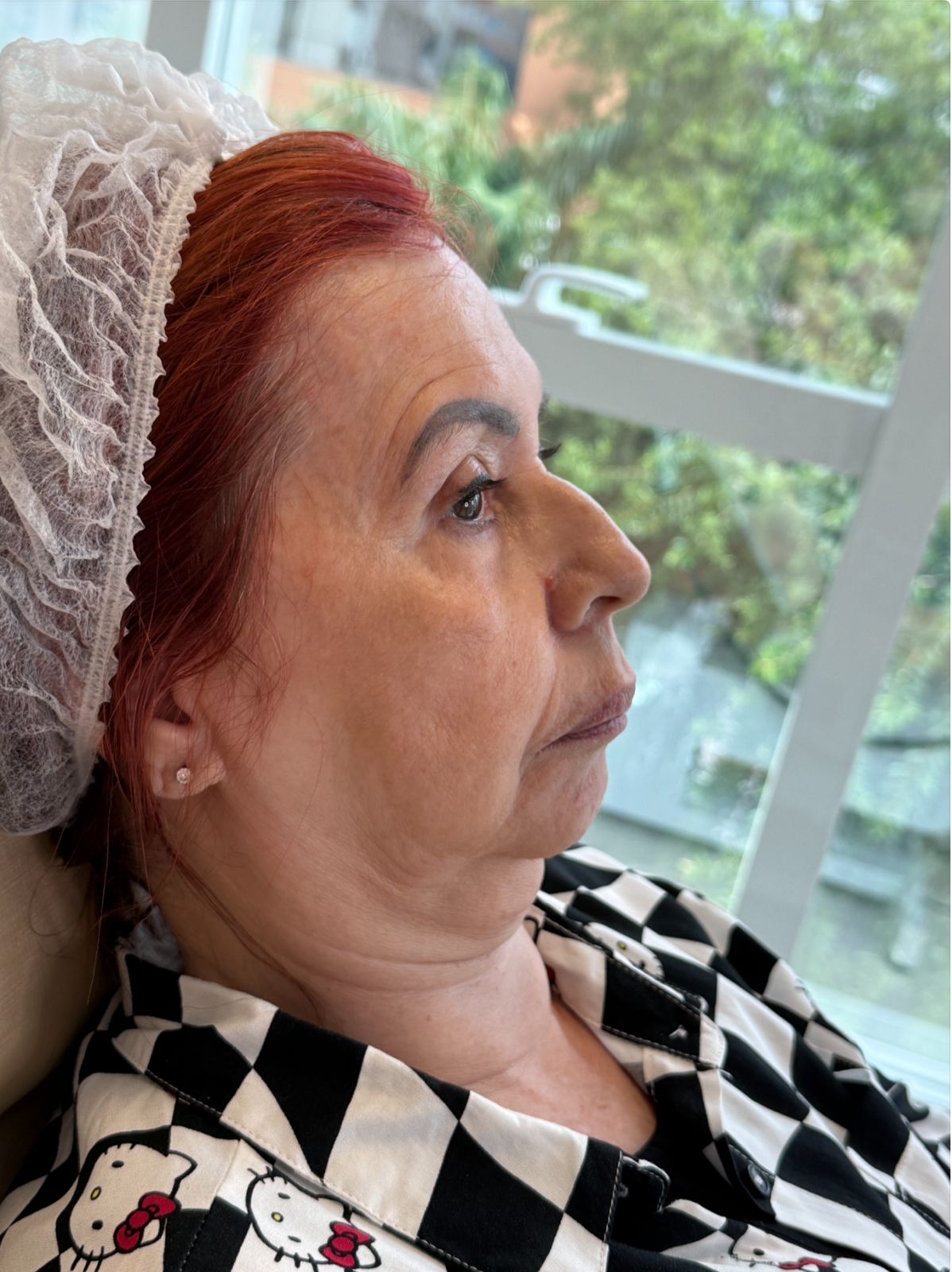 Antes - Harmonização Facial