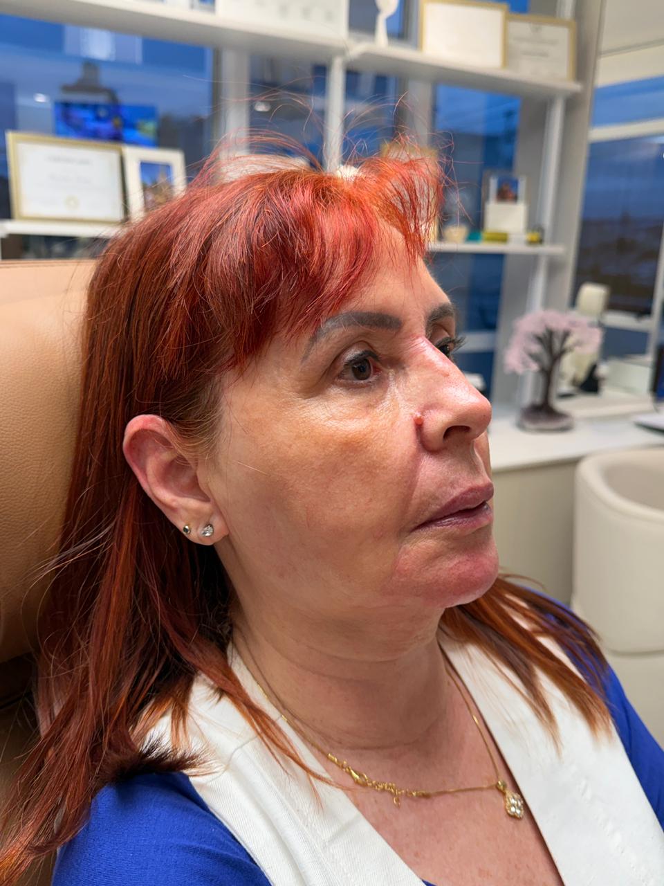 Depois - Harmonização Facial