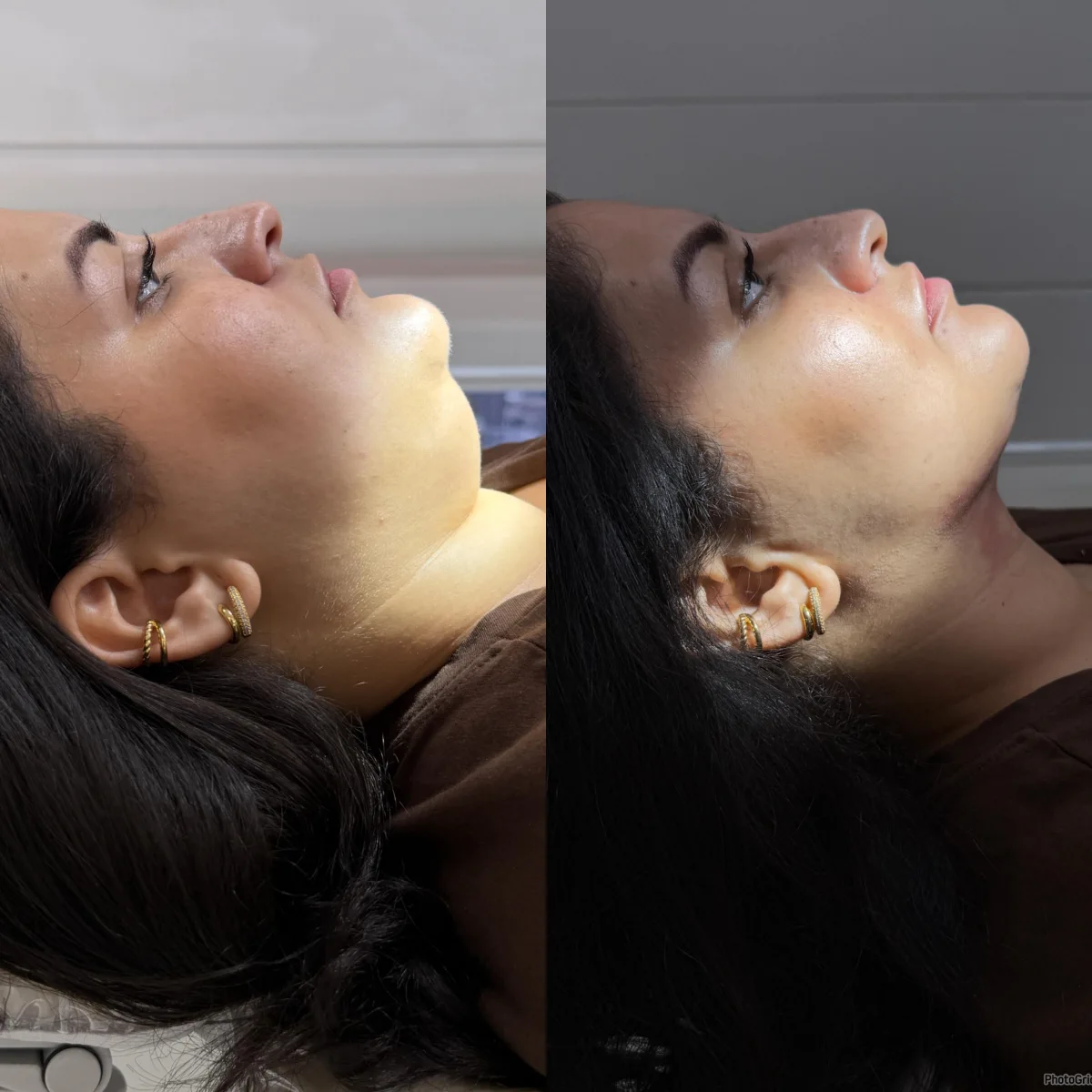 Lipo de Papada - Antes e Depois