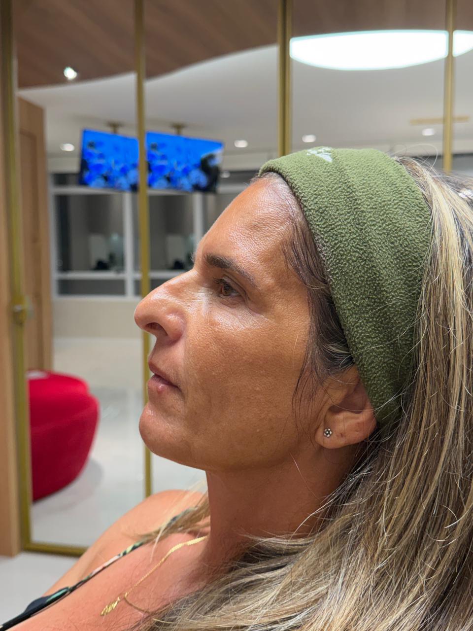 Antes - Rinomodelação